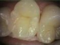Zubní výplně (záchovná stomatologie) - fotka před - ALFADENT - dentální klinika Praha 5