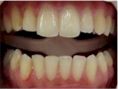 Bělení zubů - fotka před - Laser Dent - Zubní ordinace