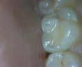 Zubní výplně (záchovná stomatologie) - fotka před - Dentim s.r.o.