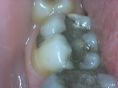 Zubní výplně (záchovná stomatologie) - fotka před - MUDr.  Kamil Beneš