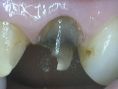 Bělení zubů - fotka před - Moravia dental center