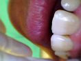 Zubní výplně (záchovná stomatologie) - fotka před - MDDr. Kristina Gomolová