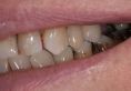 Zubní výplně (záchovná stomatologie) - fotka před - MUDr. Tomáš Sojka