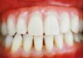 Zubní implantáty - fotka před - MUDr. Aleš Váňa