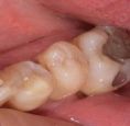 Zubní výplně (záchovná stomatologie) - fotka před - MUDr. Tomáš Sojka