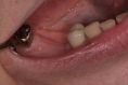 Zubní implantáty - fotka před - MUDr. Tomáš Sojka