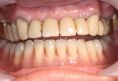 Zubní implantáty - fotka před - MUDr. Tomáš Sojka