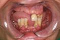 Zubní implantáty - fotka před - Diobe Dental Clinic