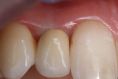 Zubní implantáty - fotka před - Diobe Dental Clinic