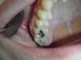 Zubní výplně (záchovná stomatologie) - fotka před - Lékařské centrum Staňkova