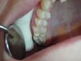 Zubní výplně (záchovná stomatologie) - fotka před - Lékařské centrum Staňkova