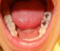 Zubní výplně (záchovná stomatologie) - fotka před - MUDr. Jakub Smrček