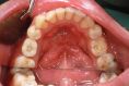 Zubní implantáty - fotka před - MUDr. Aleš Váňa