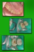 Zubní výplně (záchovná stomatologie) - fotka před - MUDr. Dimitrij Tkalych
