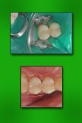 Zubní výplně (záchovná stomatologie) - fotka před - MUDr. Dimitrij Tkalych
