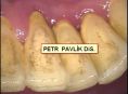 Dentální hygienista Petr Pavlík DiS. - fotka před - Dentální hygienista Petr Pavlík DiS.