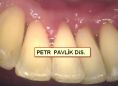 Dentální hygiena - fotka před - Dentální hygienista Petr Pavlík DiS.