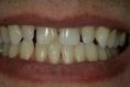 Bělení zubů - fotka před - Dentální klinika Jan Stuchlík