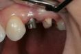 Zubní implantáty - fotka před - Dentální klinika Jan Stuchlík