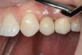 Zubní implantáty - fotka před - Dentální klinika Jan Stuchlík