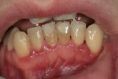 Léčba paradentózy (parodontologie) - fotka před - Dentální klinika Jan Stuchlík