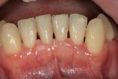 Léčba paradentózy (parodontologie) - fotka před - Dentální klinika Jan Stuchlík
