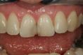 Zubní výplně (záchovná stomatologie) - fotka před - Dentální klinika Jan Stuchlík