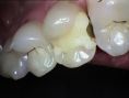 Zubní výplně (záchovná stomatologie) - fotka před - Dentální centrum Podkovka MDDr. Veronika Péková