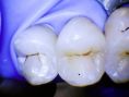 Zubní výplně (záchovná stomatologie) - fotka před - Dentální centrum Podkovka MDDr. Veronika Péková