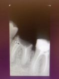 Endodoncie (ošetření kořenových kanálků) - fotka před - MDDr. Jana Beranovská