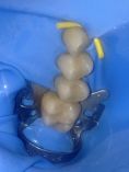 Zubní výplně (záchovná stomatologie) - fotka před - MDDr. Jana Beranovská