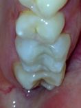 Zubní výplně (záchovná stomatologie) - fotka před - MDDr. Jana Beranovská