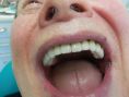 Zubní implantáty - fotka před - MUDr. Zdenek Kotek