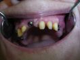 Zubní implantáty - fotka před - MUDr. Zdenek Kotek
