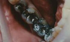 Zubní výplně (záchovná stomatologie) - fotka před - Jana Navrátilová Dr.med. dent
