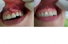 Augmentační techniky v parodontologii a implantologii - Pacientka H.K. 34 let. Byl přenesen štěp měkkých tkání z horního patra k postiženému místu. Časové rozmění mezi fotografiemi je 3 měsíce.