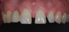 Zubní miniimplantáty - Pacient ročník 74 po selhání endodoncie zubu 12,
Dále byl pacient nespokojen s estetikou resp. mezerami chrupu
Řešení: implantáty zuby 15 a 12 a keramické fasety v zozsahu 11, 21, 22