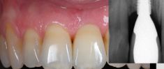Keramické korunky a můstky - Pacient  ročník 197, stav po extrakci zubu 21 pro endodontické selhání

Řešení: implantace do místa 21 s augmentací kosti a měkkých tkání a po vytvarování dásně do tvaru lůžka zubu celokeramická korunka