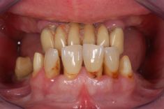 Zubní implantáty - pacient  ročník 1946, pacient přichází s totálním selháním chrupu pro parodontózu 

Řešení: po postupných extrakcích všech zubů Hč a provizorním můstku na dobu hojení implantace 8 miplantátů a v Dč okamžitá implantace 5 implantátů. Po zhojení fixní šroubovaná rekonstrukce chrupu