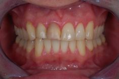 Keramické fazety - pacient  ročník 1976, stav po úrazu zubů 11 a 12 v dětství a opakované dostavbě kompozitem
Řešení: celokeramické fasety