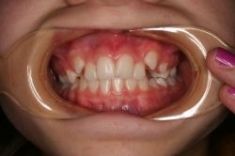 Ortodoncie - fotka před