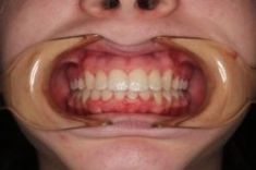 Ortodoncie - fotka před - MUDr. Petr Vinš