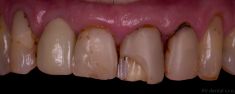 Zubní výplně (záchovná stomatologie) - sanace zubu + kompozitní výplně