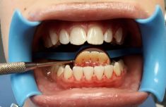 Dentální hygiena - Odstranění pigmentů metodou air flow.