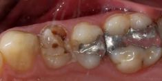 Zubní výplně (záchovná stomatologie) - sanace zubu + kompozitní výplně