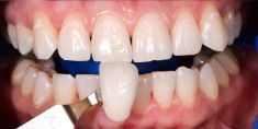 Bělení zubů - Ordinační bělení zubů Philips ZOOM, stav před a po.
Archiv: RB dent - MUDr. Richard Benko