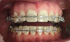 Dentální hygiena - Zubní hygiena u pacienta s rovnátky, GBT (guided biofilm therapy). 
Archiv: RB dent - MUDr. Richard Benko
