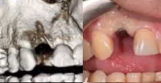 Zubní implantáty - Náhrada dvojky nahoře, zubní implantát, stav před a po + detail náhrady.
Archiv: RB dent - MUDr. Richard Benko