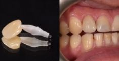 Zubní implantáty - Náhrada dvojky nahoře, zubní implantát, stav před a po + detail náhrady.
Archiv: RB dent - MUDr. Richard Benko