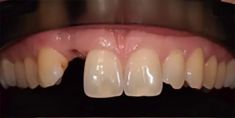 RB Dent - centrum komplexní stomatologie - Náhrada chybějícího zubu pomocí zubního implantátu, stav před a po. 
Archiv: RB dent   Liberec - MUDr. Richard Benko